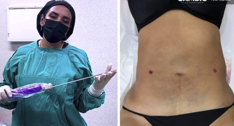 Clínica clandestina “Detox” ofrecía procedimientos estéticos de alto riesgo sin supervisión profesional